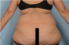 Liposuction Before Photo by Ellen Janetzke, MD; Bloomfield Hills, MI - Case 50079