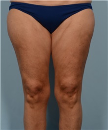 Liposuction After Photo by Ellen Janetzke, MD; Bloomfield Hills, MI - Case 50078