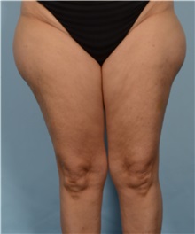 Liposuction Before Photo by Ellen Janetzke, MD; Bloomfield Hills, MI - Case 50078