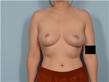 Breast Reduction After Photo by Ellen Janetzke, MD; Bloomfield Hills, MI - Case 50127
