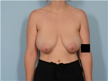 Breast Reduction Before Photo by Ellen Janetzke, MD; Bloomfield Hills, MI - Case 50127