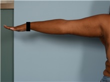 Arm Lift After Photo by Ellen Janetzke, MD; Bloomfield Hills, MI - Case 50128 Arm Lift After Photo by Ellen Janetzke, MD; Bloomfield Hills, MI - Case 50128
