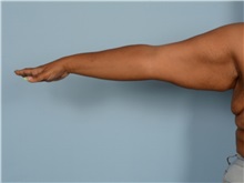 Arm Lift Before Photo by Ellen Janetzke, MD; Bloomfield Hills, MI - Case 50128 Arm Lift Before Photo by Ellen Janetzke, MD; Bloomfield Hills, MI - Case 50128