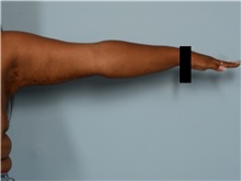 Arm Lift After Photo by Ellen Janetzke, MD; Bloomfield Hills, MI - Case 50128