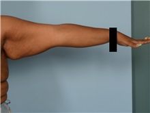 Arm Lift Before Photo by Ellen Janetzke, MD; Bloomfield Hills, MI - Case 50128