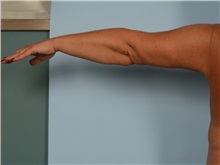 Arm Lift After Photo by Ellen Janetzke, MD; Bloomfield Hills, MI - Case 50125 Arm Lift After Photo by Ellen Janetzke, MD; Bloomfield Hills, MI - Case 50125
