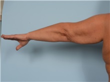 Arm Lift Before Photo by Ellen Janetzke, MD; Bloomfield Hills, MI - Case 50125 Arm Lift Before Photo by Ellen Janetzke, MD; Bloomfield Hills, MI - Case 50125