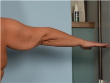 Arm Lift Before Photo by Ellen Janetzke, MD; Bloomfield Hills, MI - Case 50125
