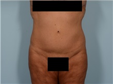 Tummy Tuck After Photo by Ellen Janetzke, MD; Bloomfield Hills, MI - Case 50126 Tummy Tuck After Photo by Ellen Janetzke, MD; Bloomfield Hills, MI - Case 50126
