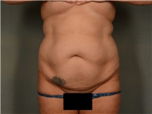 Tummy Tuck Before Photo by Ellen Janetzke, MD; Bloomfield Hills, MI - Case 50126 Tummy Tuck Before Photo by Ellen Janetzke, MD; Bloomfield Hills, MI - Case 50126