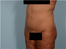 Tummy Tuck After Photo by Ellen Janetzke, MD; Bloomfield Hills, MI - Case 50126