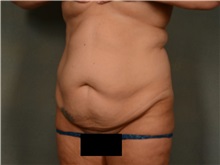 Tummy Tuck Before Photo by Ellen Janetzke, MD; Bloomfield Hills, MI - Case 50126