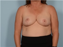 Breast Reduction After Photo by Ellen Janetzke, MD; Bloomfield Hills, MI - Case 50130 Breast Reduction After Photo by Ellen Janetzke, MD; Bloomfield Hills, MI - Case 50130