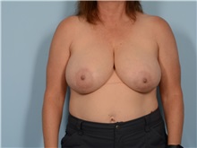 Breast Reduction Before Photo by Ellen Janetzke, MD; Bloomfield Hills, MI - Case 50130 Breast Reduction Before Photo by Ellen Janetzke, MD; Bloomfield Hills, MI - Case 50130