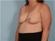 Breast Reduction After Photo by Ellen Janetzke, MD; Bloomfield Hills, MI - Case 50130