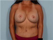 Breast Implant Revision After Photo by Ellen Janetzke, MD; ,  - Case 50222