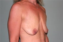Breast Lift Before Photo by Paul Rhee, MD, FACS; Castle Rock, CO - Case 22405