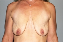 Breast Lift Before Photo by Paul Rhee, MD, FACS; Castle Rock, CO - Case 22405