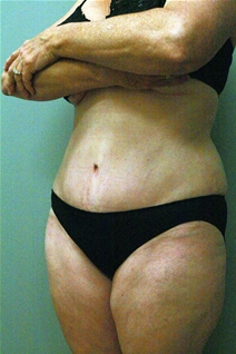 Tummy Tuck After Photo by Paul Rhee, MD, FACS; Castle Rock, CO - Case 22685