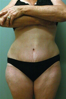 Tummy Tuck After Photo by Paul Rhee, MD, FACS; Castle Rock, CO - Case 22685