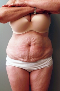 Tummy Tuck Before Photo by Paul Rhee, MD, FACS; Castle Rock, CO - Case 22685