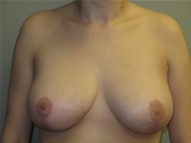 Breast Reduction After Photo by Paul Rhee, MD, FACS; Castle Rock, CO - Case 23475