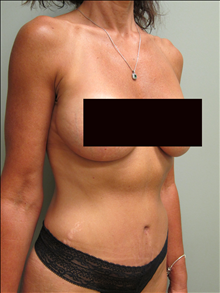 Tummy Tuck After Photo by Paul Rhee, MD, FACS; Castle Rock, CO - Case 23862