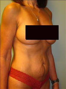 Tummy Tuck Before Photo by Paul Rhee, MD, FACS; Castle Rock, CO - Case 23862