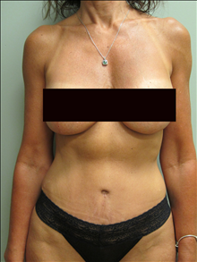 Tummy Tuck After Photo by Paul Rhee, MD, FACS; Castle Rock, CO - Case 23862