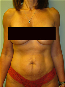 Tummy Tuck Before Photo by Paul Rhee, MD, FACS; Castle Rock, CO - Case 23862
