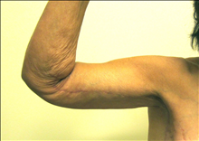 Body Contouring After Photo by Paul Rhee, MD, FACS; Castle Rock, CO - Case 24134