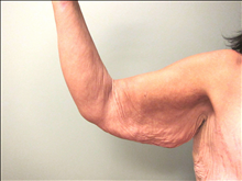 Body Contouring Before Photo by Paul Rhee, MD, FACS; Castle Rock, CO - Case 24134