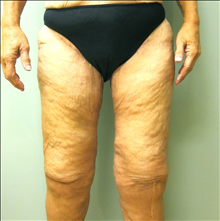 Body Contouring After Photo by Paul Rhee, MD, FACS; Castle Rock, CO - Case 24134