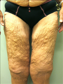 Body Contouring Before Photo by Paul Rhee, MD, FACS; Castle Rock, CO - Case 24134