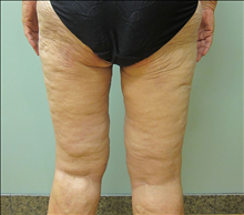 Body Contouring After Photo by Paul Rhee, MD, FACS; Castle Rock, CO - Case 24134