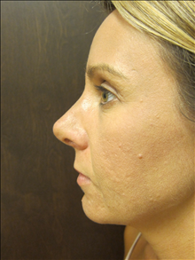 Rhinoplasty After Photo by Paul Rhee, MD, FACS; Castle Rock, CO - Case 24711