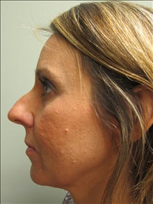 Rhinoplasty Before Photo by Paul Rhee, MD, FACS; Castle Rock, CO - Case 24711