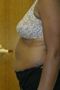 Liposuction Before Photo by Paul Rhee, MD, FACS; Castle Rock, CO - Case 4990