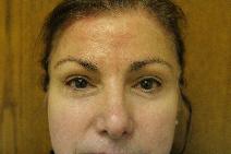 Eyelid Surgery After Photo by Paul Rhee, MD, FACS; Castle Rock, CO - Case 6552