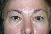 Eyelid Surgery Before Photo by Paul Rhee, MD, FACS; Castle Rock, CO - Case 6552
