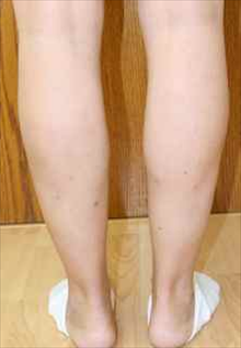 Liposuction After Photo by Paul Rhee, MD, FACS; Castle Rock, CO - Case 7029