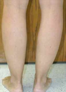 Liposuction Before Photo by Paul Rhee, MD, FACS; Castle Rock, CO - Case 7029