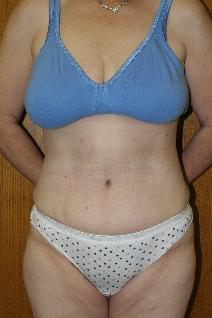 Tummy Tuck After Photo by Paul Rhee, MD, FACS; Castle Rock, CO - Case 8062