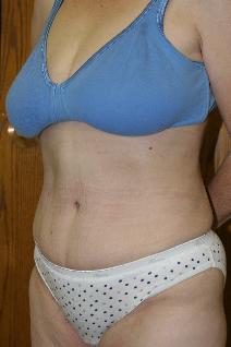 Tummy Tuck After Photo by Paul Rhee, MD, FACS; Castle Rock, CO - Case 8062