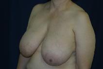 Breast Reduction Before Photo by Paul Rhee, MD, FACS; Castle Rock, CO - Case 8837