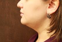 Liposuction After Photo by Paul Rhee, MD, FACS; Castle Rock, CO - Case 9016