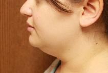 Liposuction Before Photo by Paul Rhee, MD, FACS; Castle Rock, CO - Case 9016