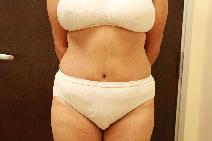Tummy Tuck After Photo by Paul Rhee, MD, FACS; Castle Rock, CO - Case 9055