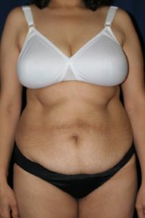 Tummy Tuck Before Photo by Paul Rhee, MD, FACS; Castle Rock, CO - Case 9055