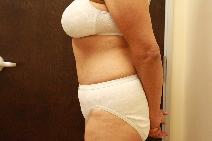 Tummy Tuck After Photo by Paul Rhee, MD, FACS; Castle Rock, CO - Case 9055